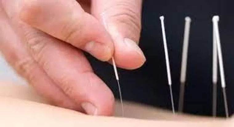 What is Acupuncture? : फायदे, इलाज और साइड-इफेक्ट्स